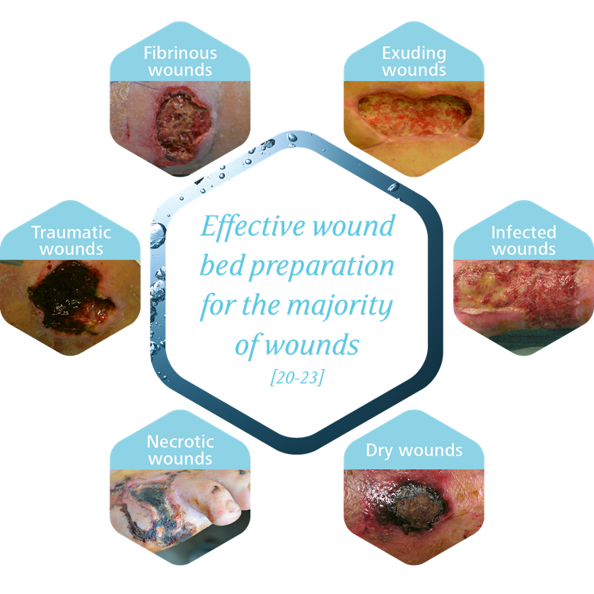 HydroClean® plus can be used for effective wound bed preparation for the majority of wounds.